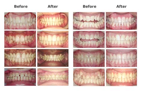 cheapest braces in the reno area